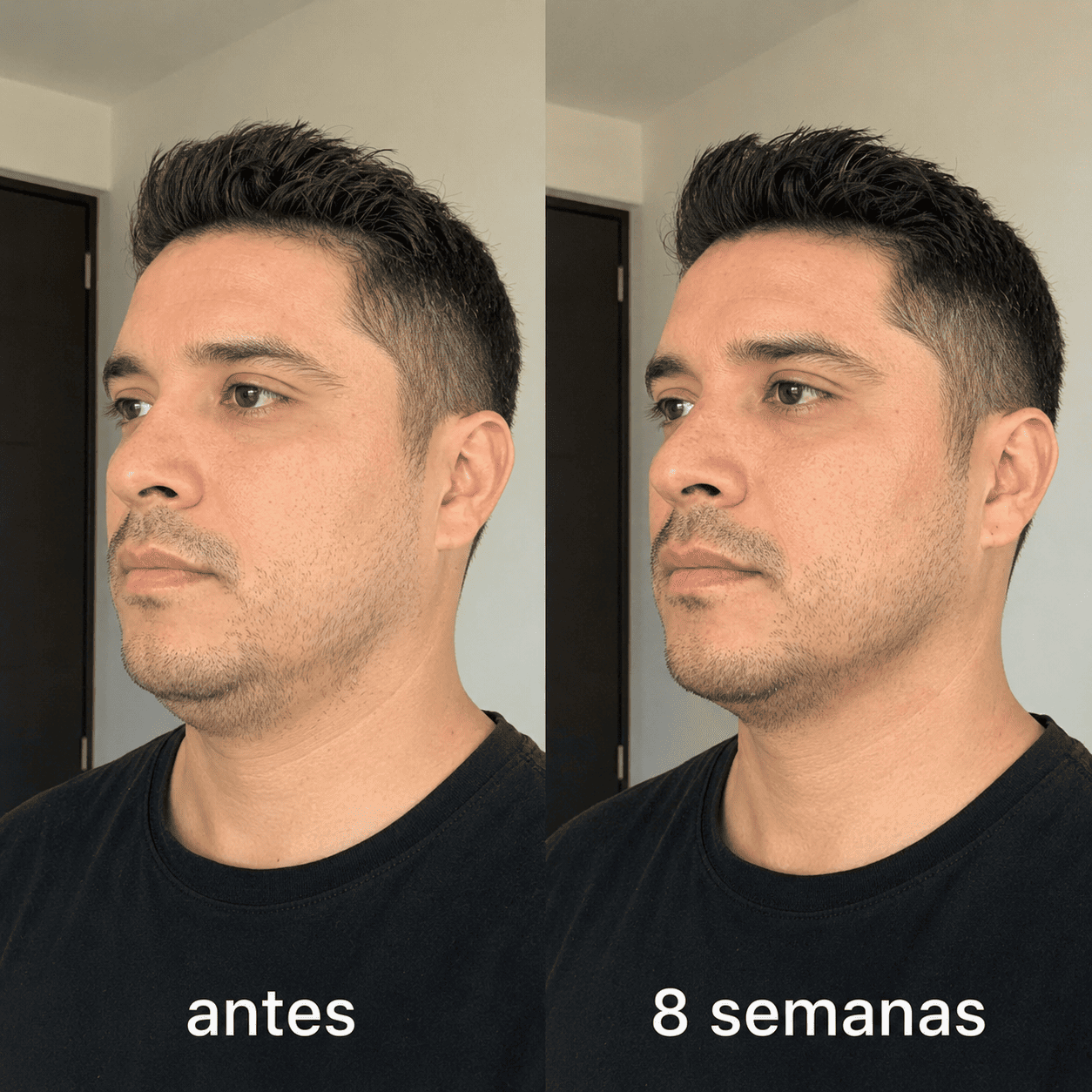 ELÁRA™ Banda Moldeadora de Colágeno