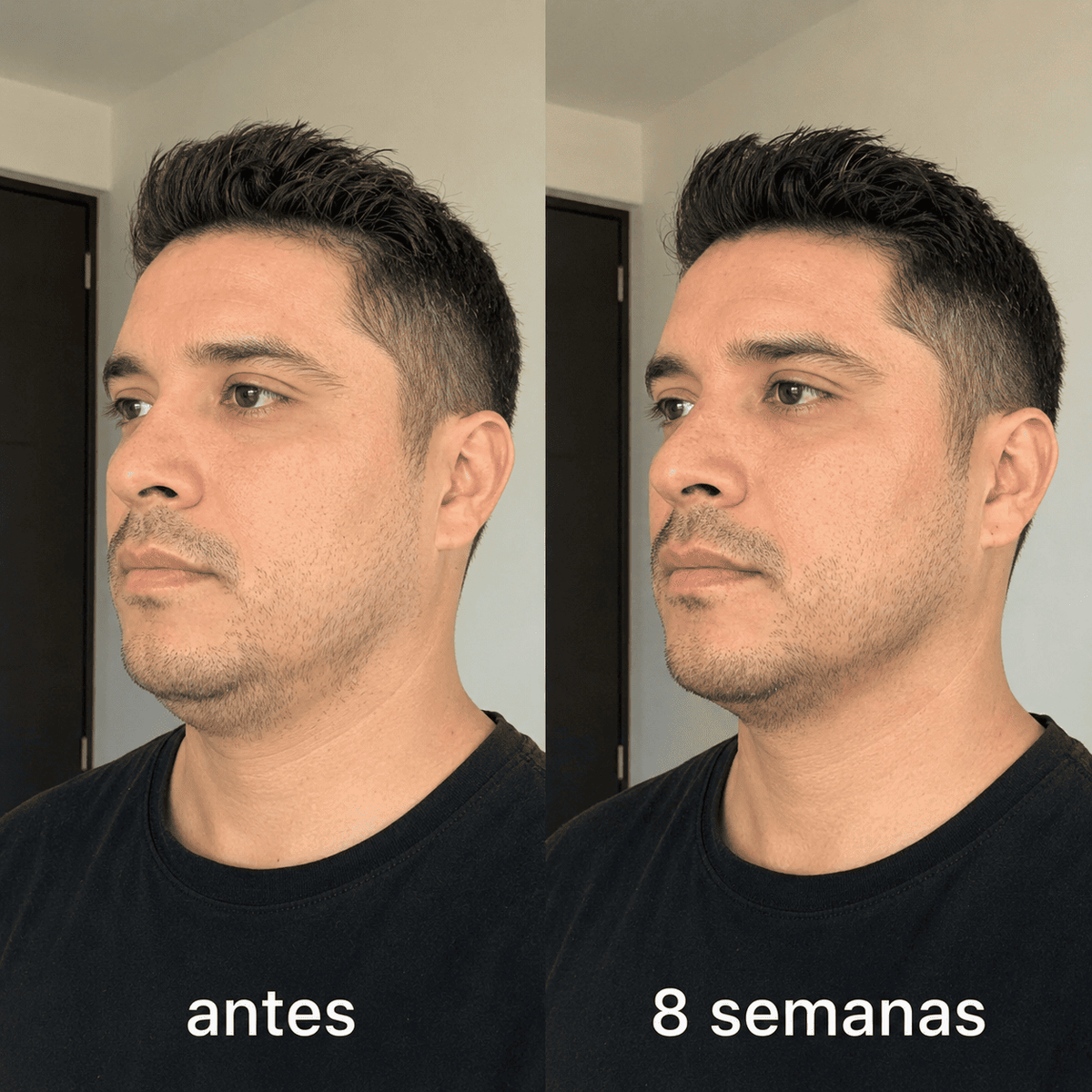 ELÁRA™ Banda Moldeadora de Colágeno