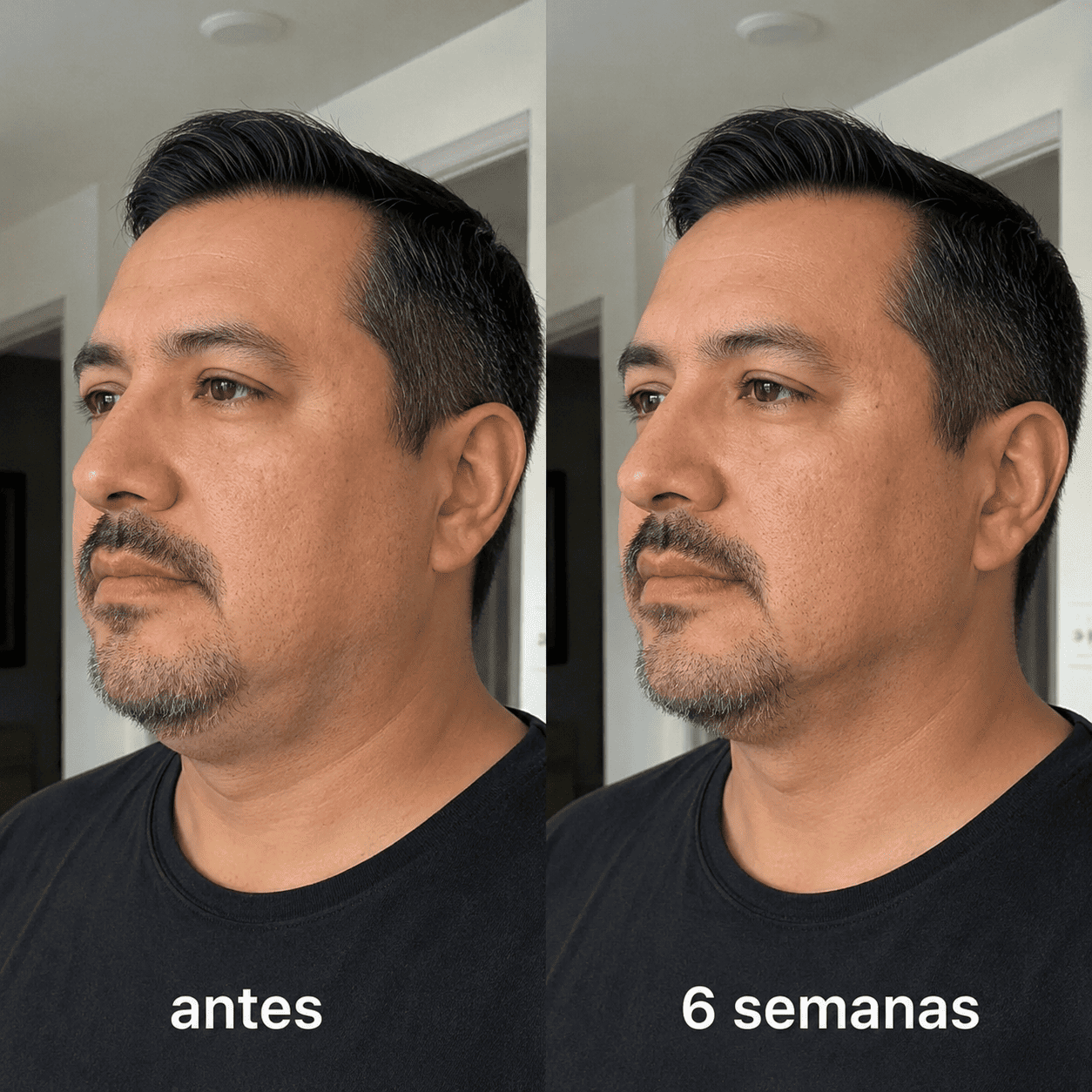 ELÁRA™ Banda Moldeadora de Colágeno