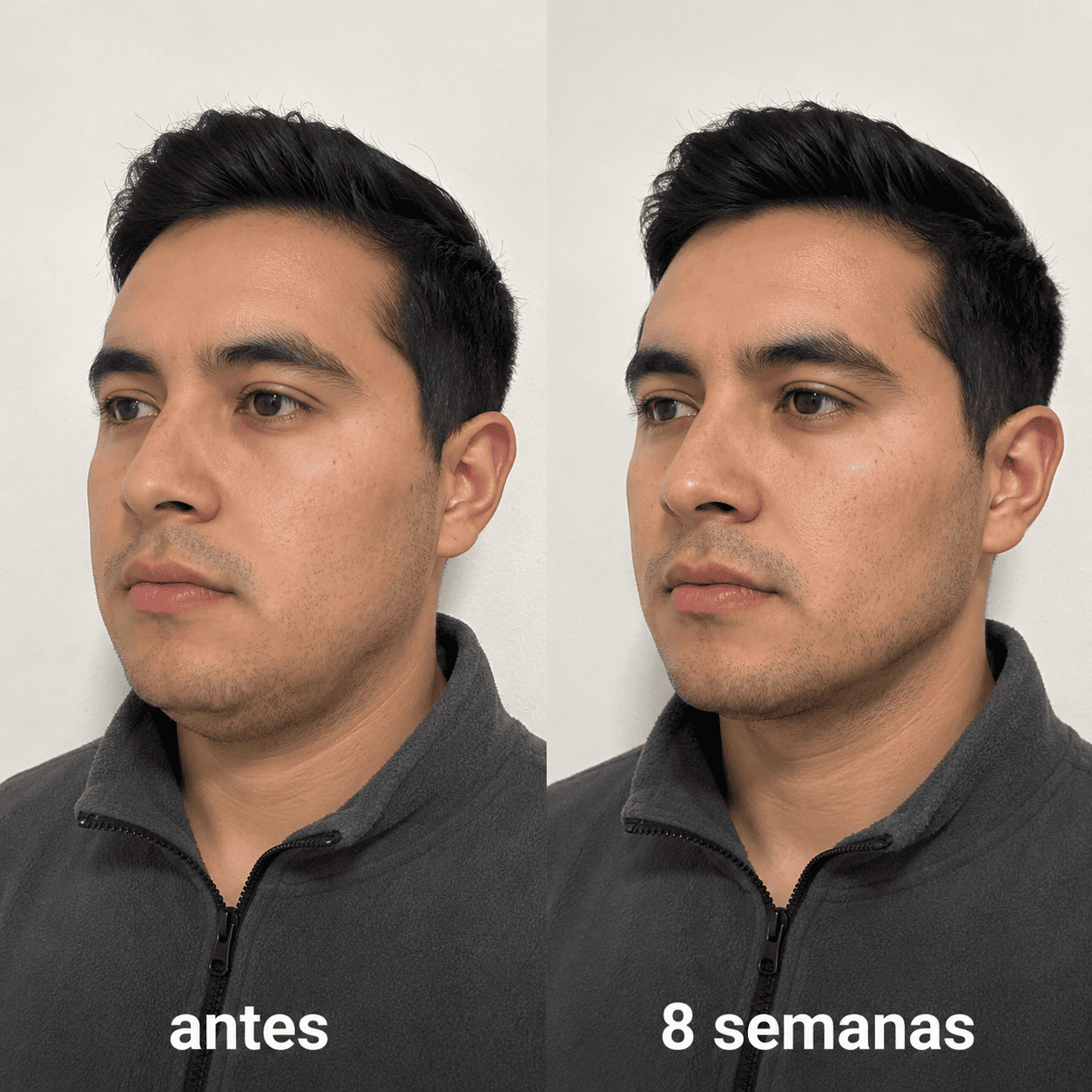 ELÁRA™ Banda Moldeadora de Colágeno