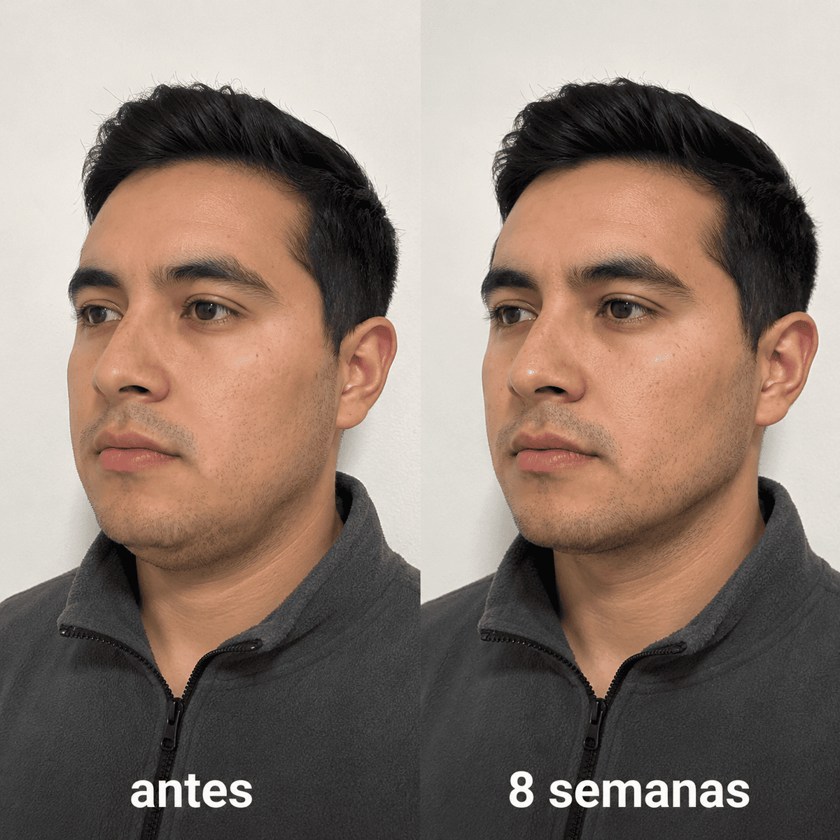 ELÁRA™ Banda Moldeadora de Colágeno
